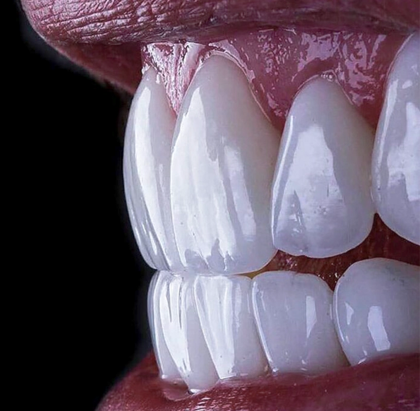 foto-de-dientes-con-carillas